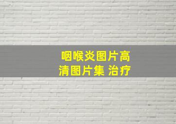 咽喉炎图片高清图片集 治疗